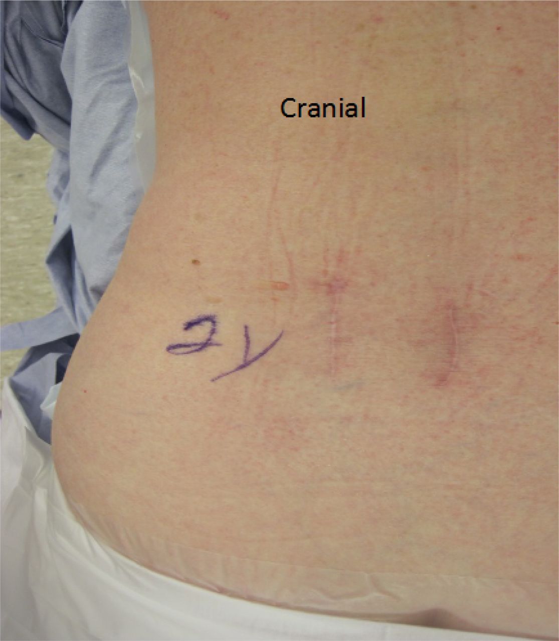 microdiscectomy scar