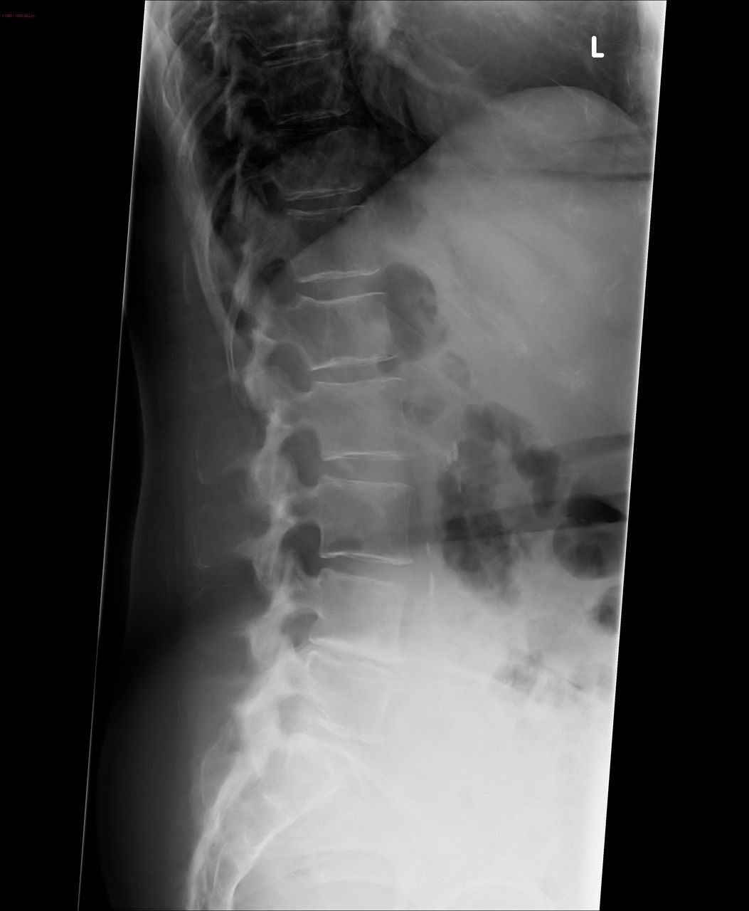 Paraplegia Secondary to Plasmacytoma of the Lumbar Spine ...