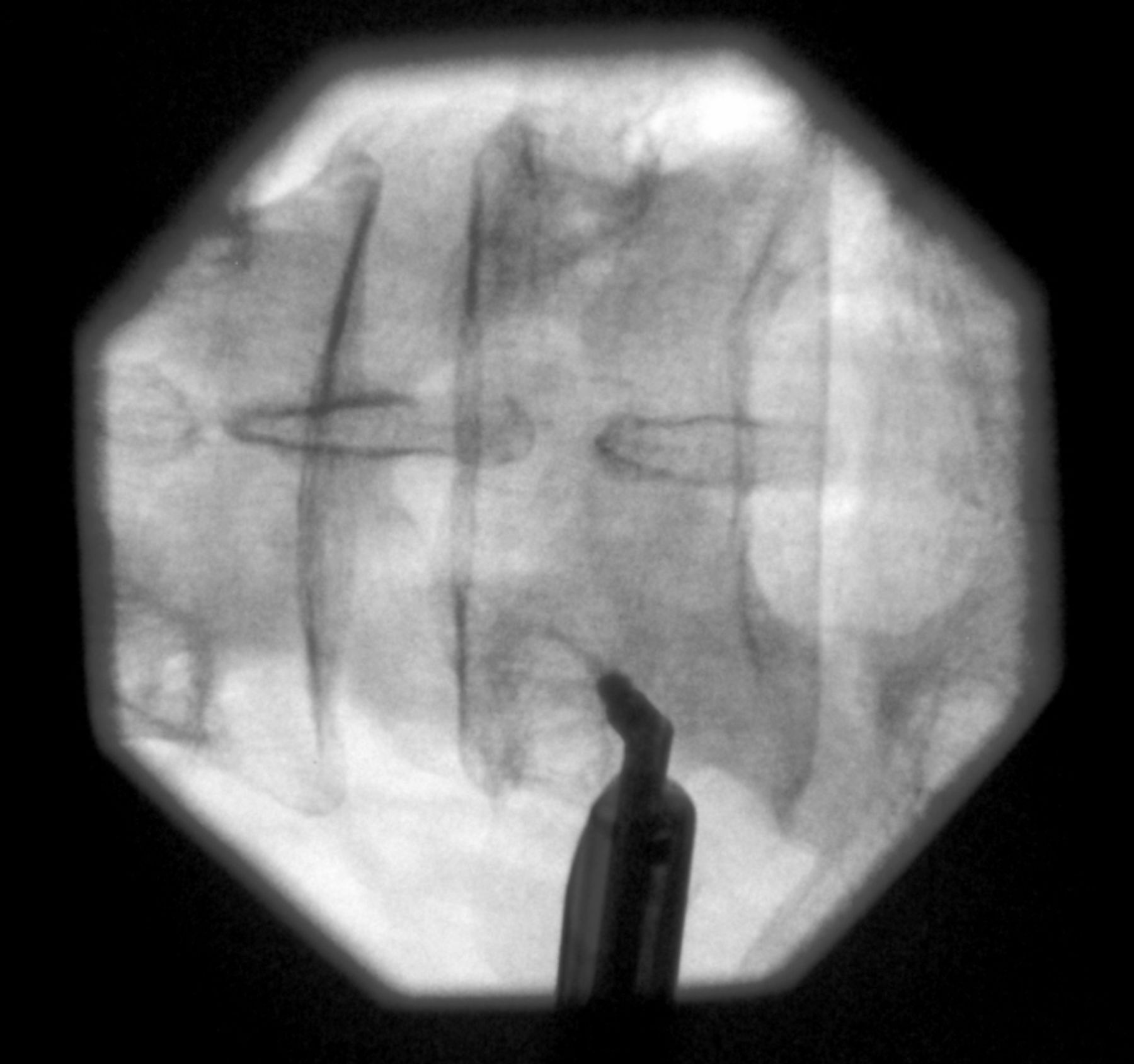 Long Term Clinical Outcomes Following Endoscopic Foraminoplasty For Patients With Single Level 