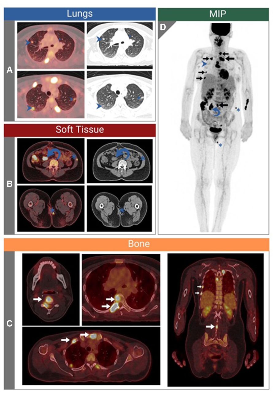 Diffuse Sarcoidosis Presenting as Metastatic Malignant Disease